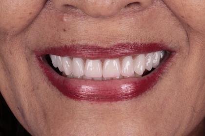 Protocolo All-on-Four