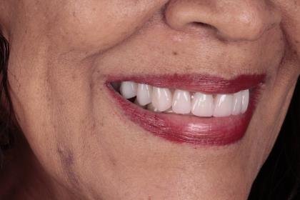 Protocolo All-on-Four