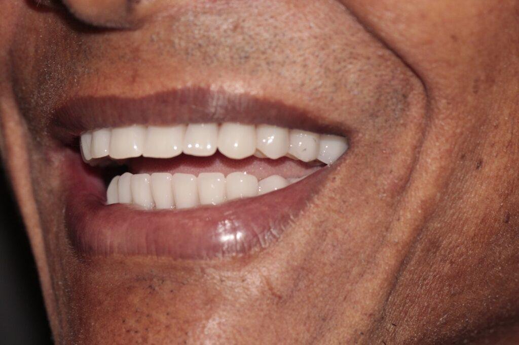 Protocolo All-on-Four