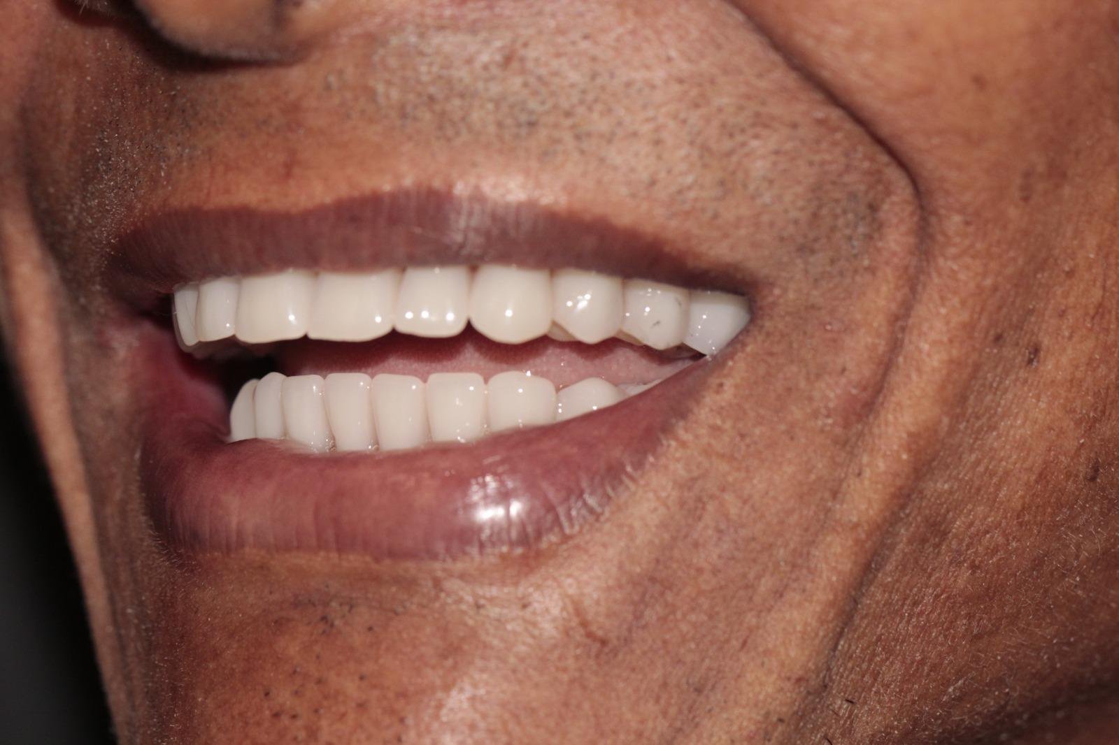 Protocolo All-on-Four