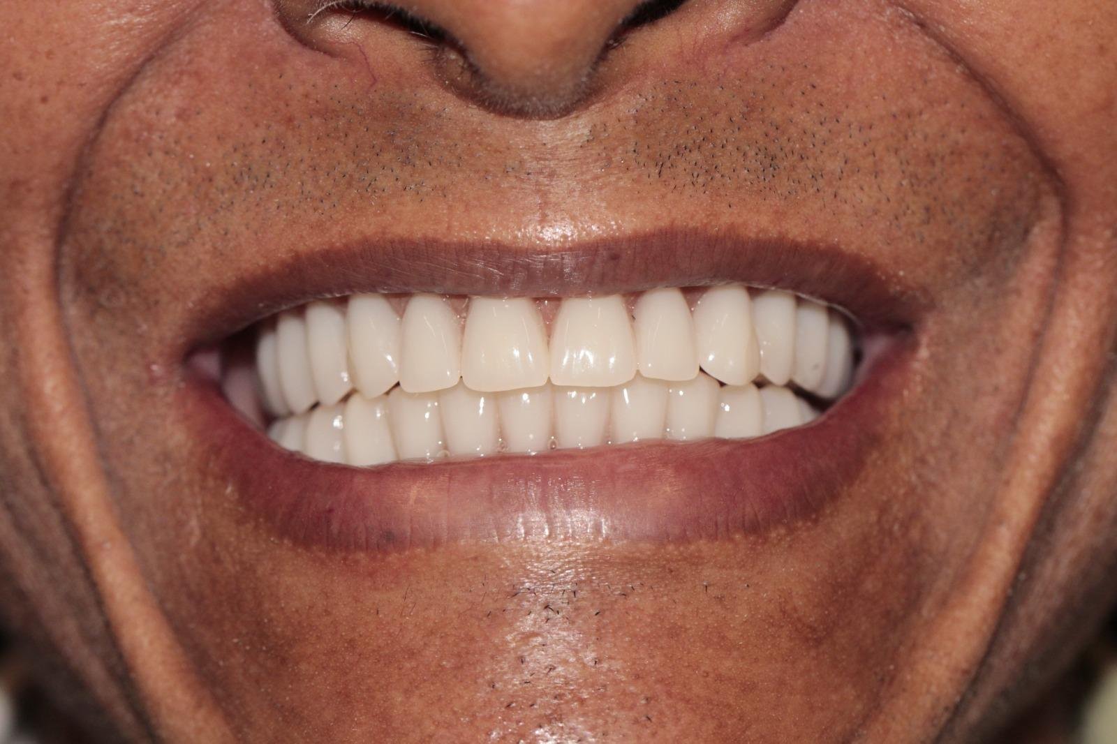 Protocolo All-on-Four