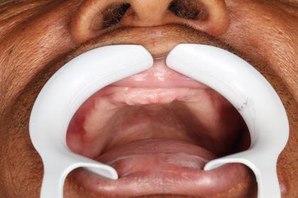 Protocolo All-on-Four