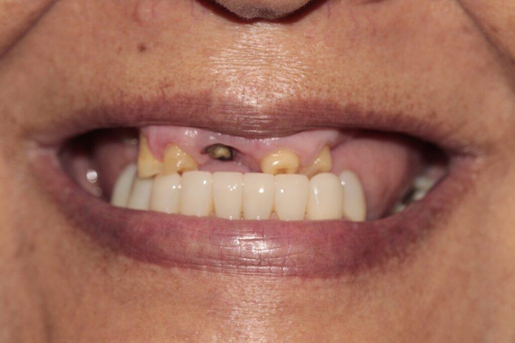 Protocolo All-on-Four