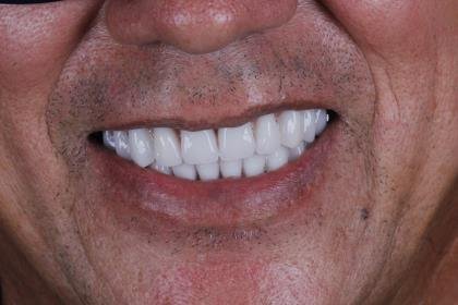 Protocolo All-on-Four