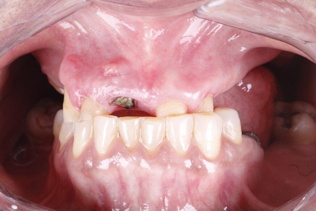 Protocolo All-on-Four