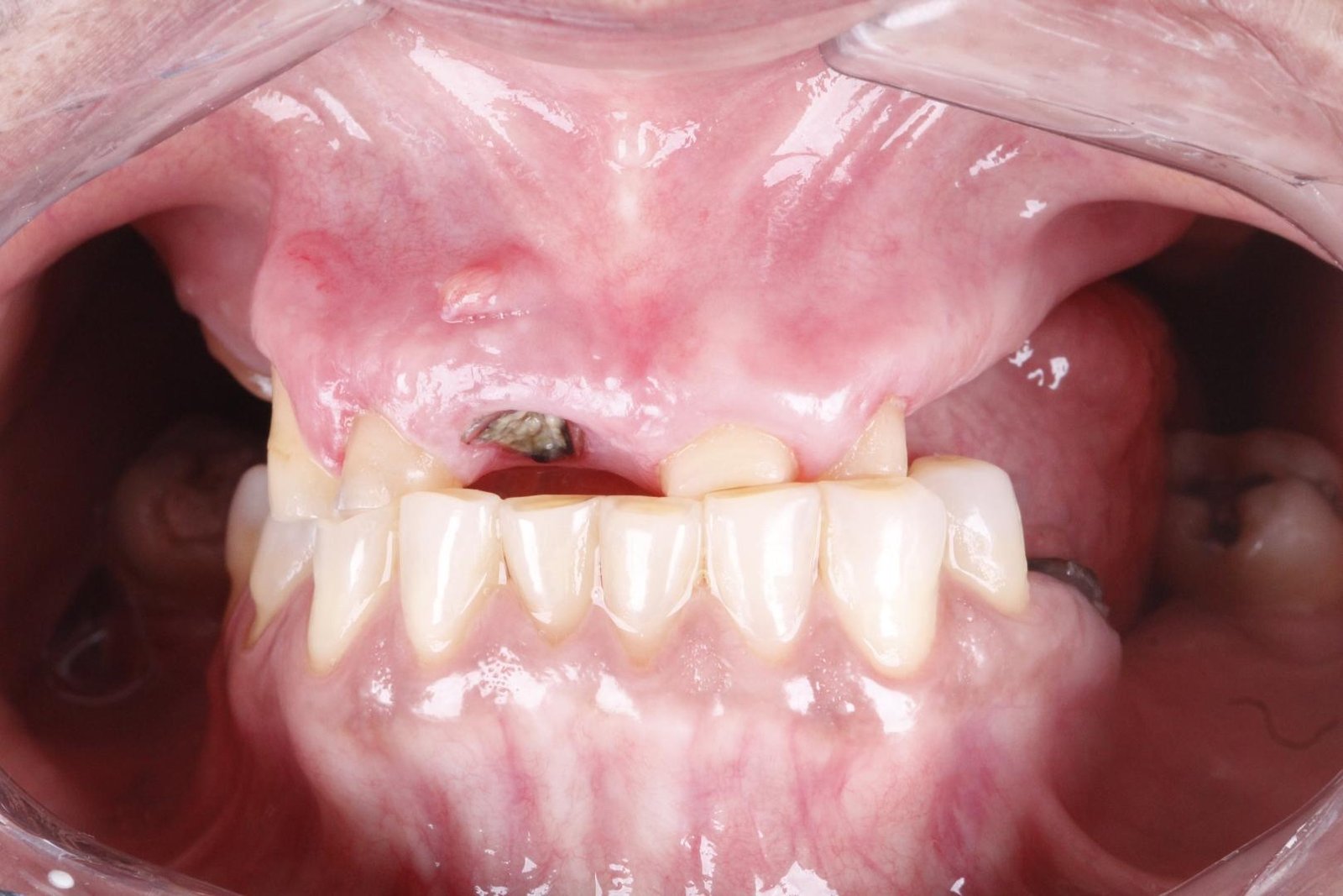 Protocolo All-on-Four