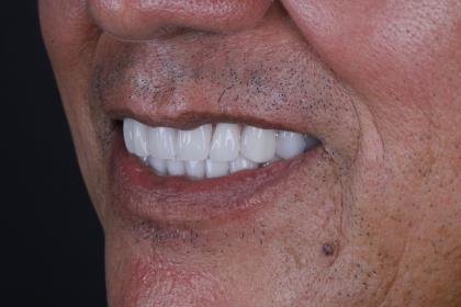 Protocolo All-on-Four