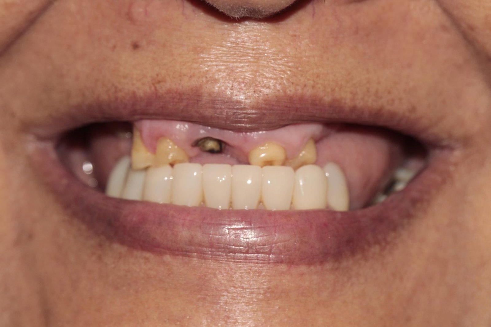 Protocolo All-on-Four