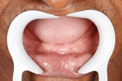 Protocolo All-on-Four