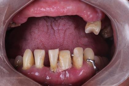 Protocolo All-on-Four