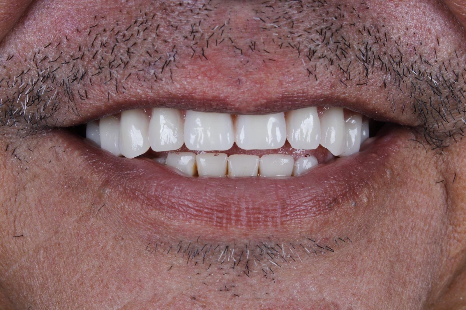 Protocolo All-on-Four