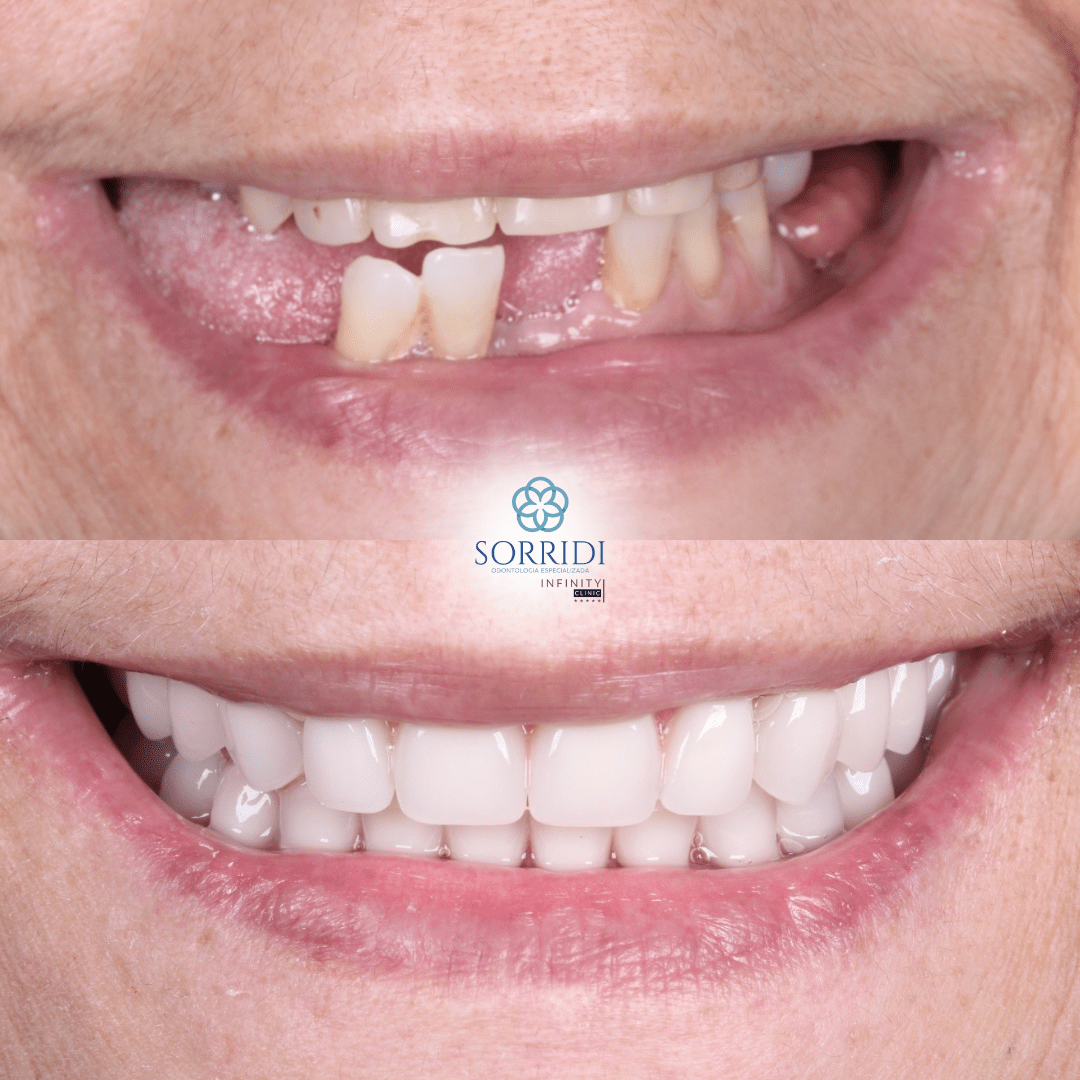 protocolo superior e inferior