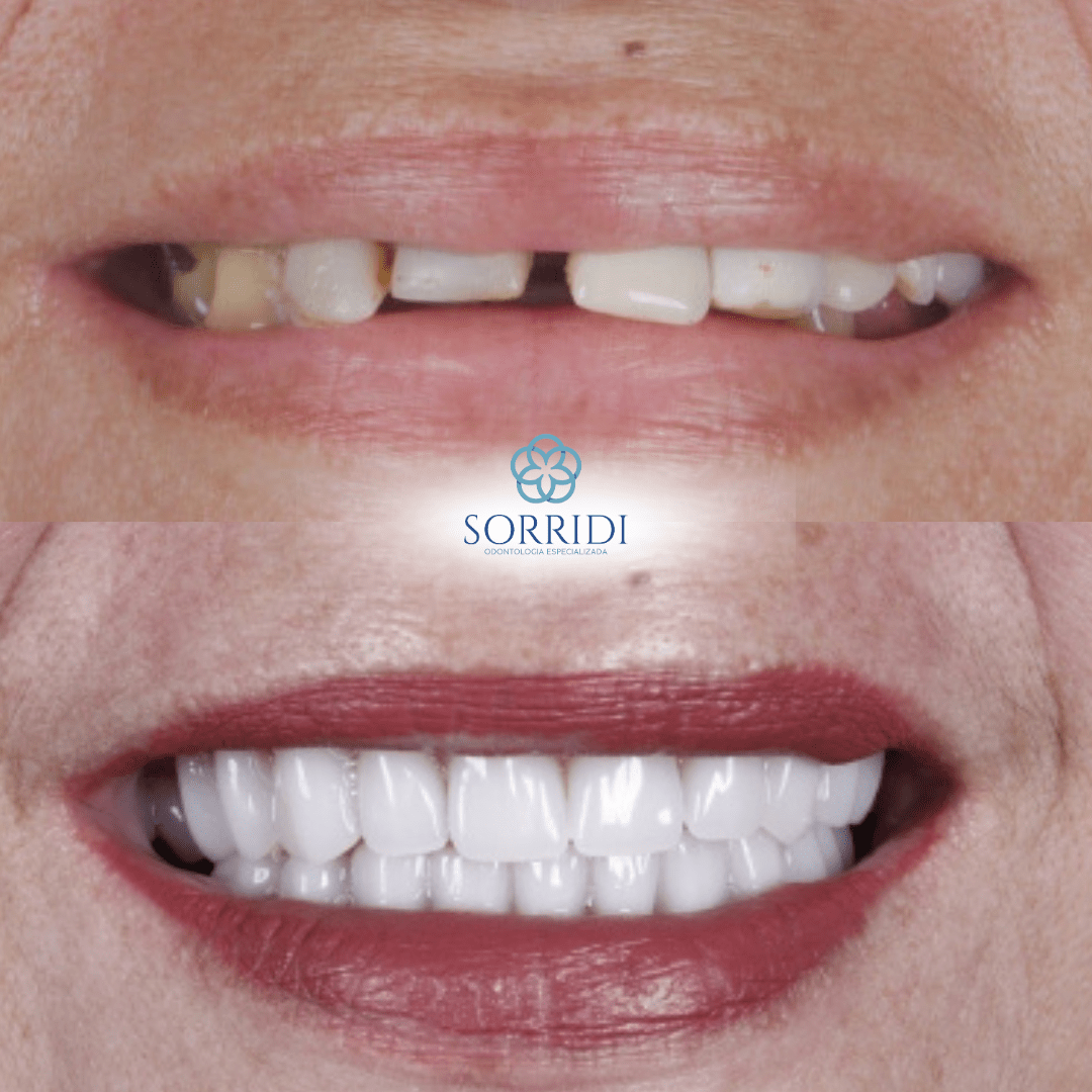 protocolo superior e inferior