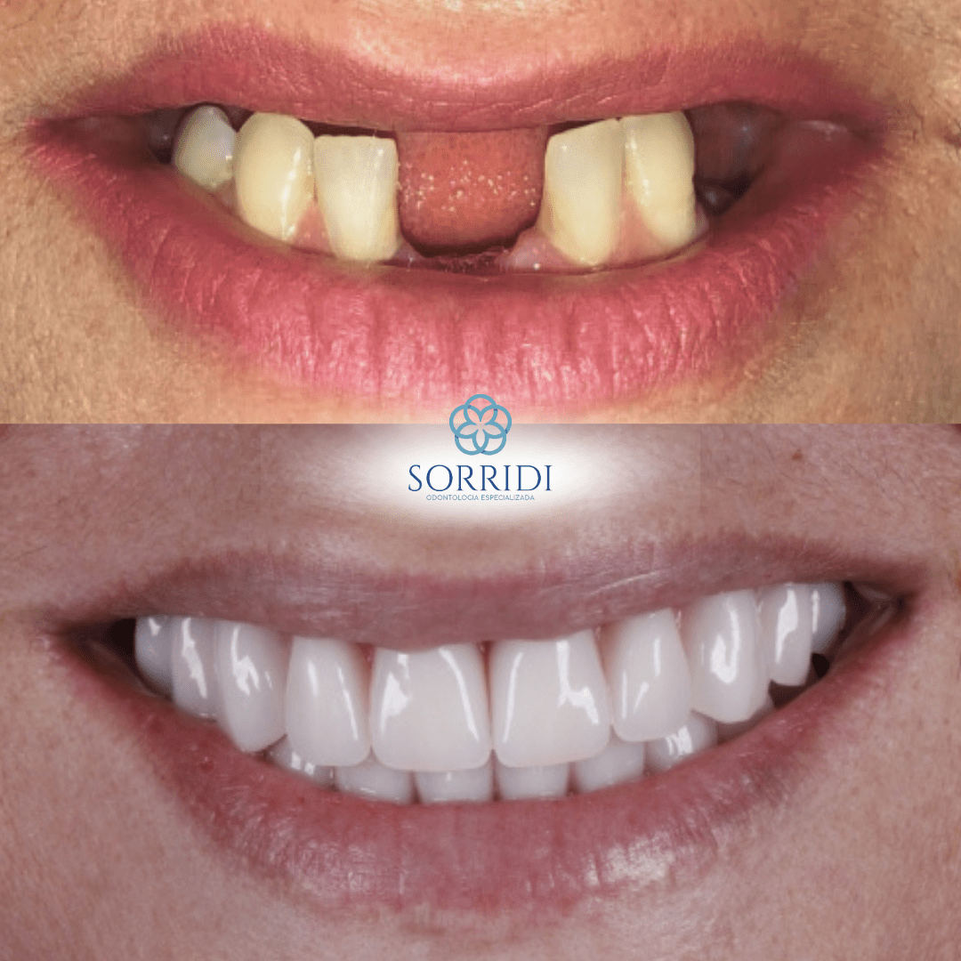 protocolo superior e inferior