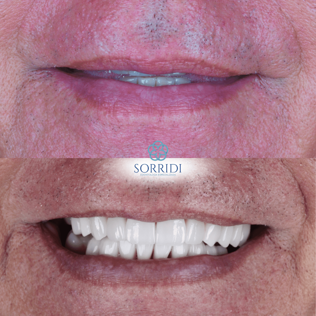 protocolo superior e inferior