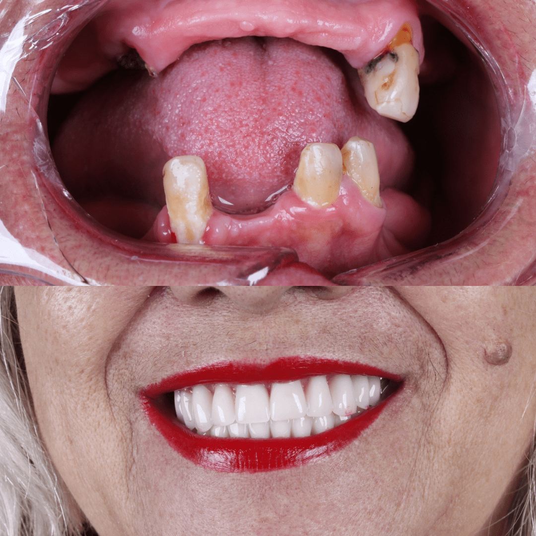 All-on-Four: a técnica que devolve sorriso fixo e qualidade de vida