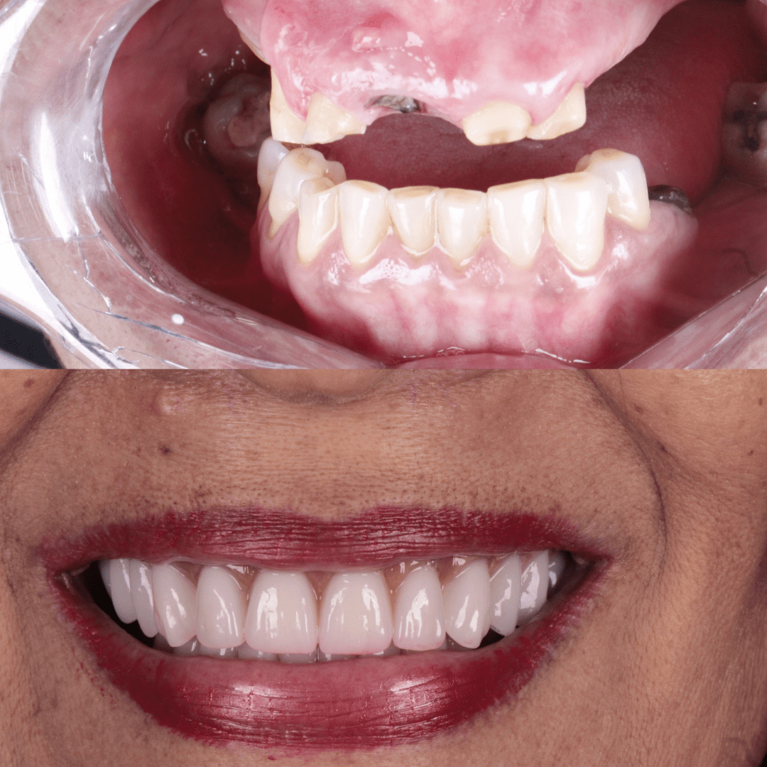 Protocolo All-on-Four