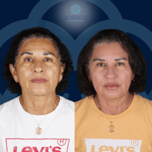 Harmonização Orofacial: rejuvenescimento natural sem cirurgia