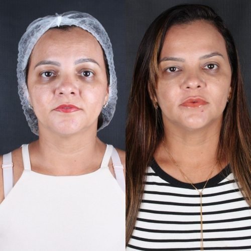 Harmonização Orofacial