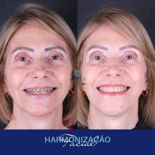 Harmoniza&ccedil;&atilde;o Orofacial