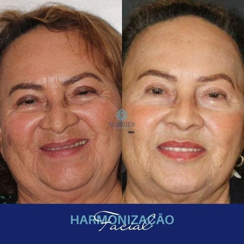 Harmonização Orofacial