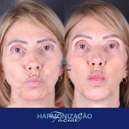 Harmonização Orofacial