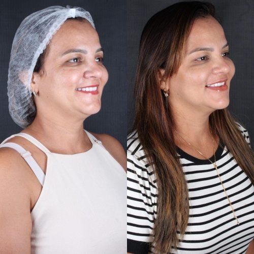 Harmonização Orofacial