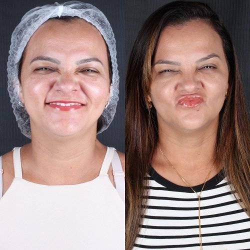 Harmonização Orofacial