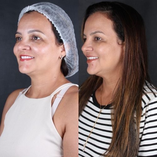 Harmoniza&ccedil;&atilde;o Orofacial