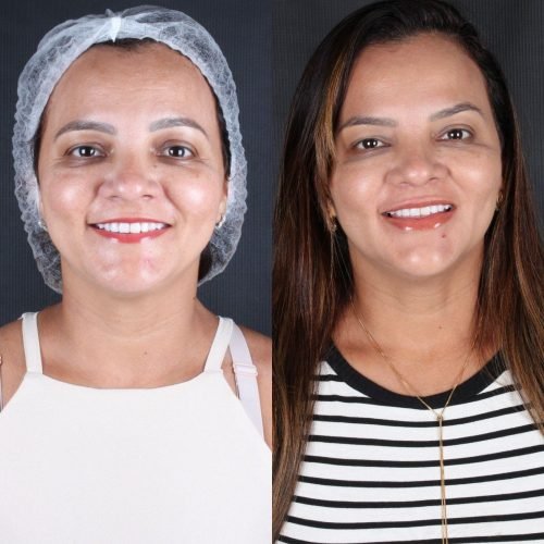 Harmonização Orofacial