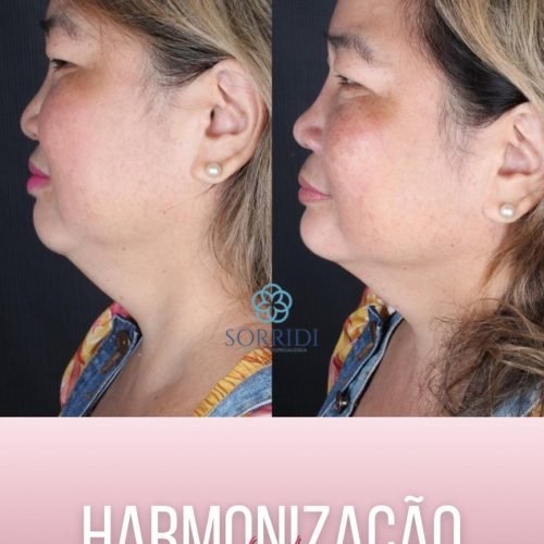 Harmonização Orofacial