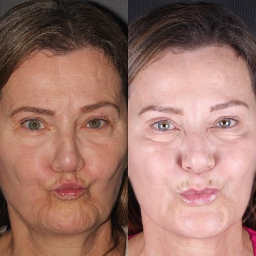 Harmonização Orofacial