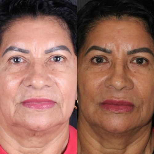 Harmonização Orofacial