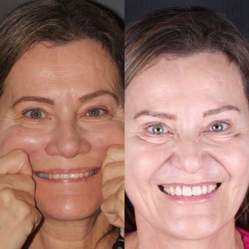 Harmonização Orofacial