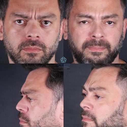 Harmonização Orofacial