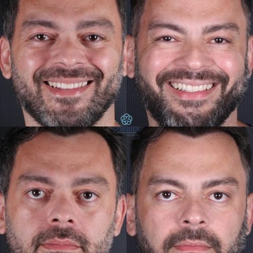 Harmonização Orofacial