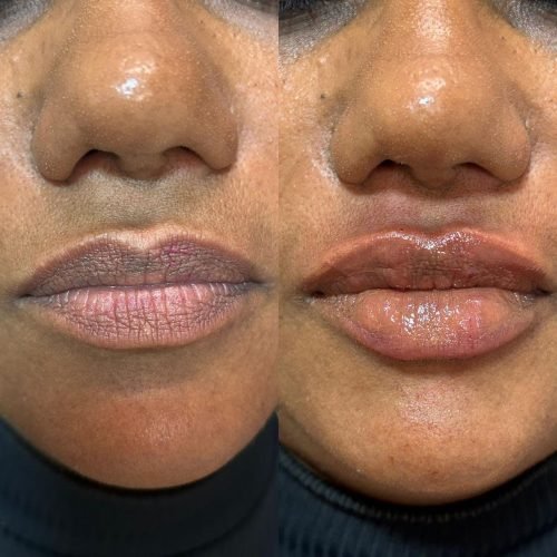 Preenchimento labial