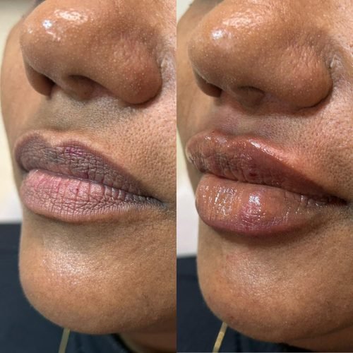 Preenchimento labial