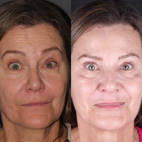 Preenchimento labial